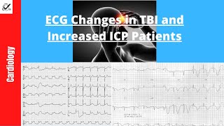 ECG Changes in TBI and Increased ICP Patients STEMI Mimic and Cerebral T Waves [upl. by Julita]