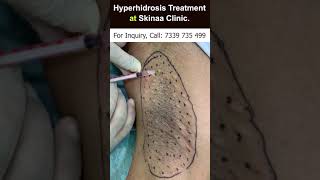 Hyperhidrosis Treatment at Skinaa Clinic  Viral shorts [upl. by Gav]