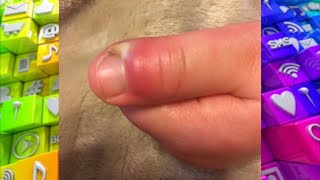 How to Spot an Infection around the Nail [upl. by Whipple403]