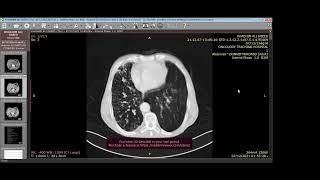 Lymphangitis carcinomatosa [upl. by Eirollam]