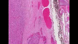 Histopathology ThyroidFollicular carcinoma [upl. by Airetal]