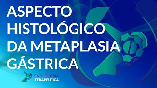 Aspecto histológico da metaplasia gástrica [upl. by Dloraj]