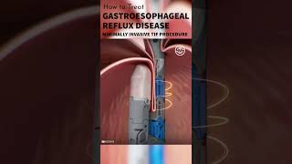 Gastroesophageal Reflux Disease GERD Treatment shorts tutorial medical animation surgmedia [upl. by Halilahk]