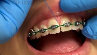 Flossing Braces With a Threader [upl. by Egedan]