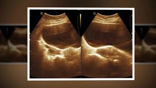 Ultrasound cases 438 of 2000  Debris in Urinary Bladder Fatty Liver Myoma Right Adnexal Cyst [upl. by Anatnas884]