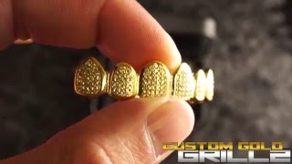 18k Canary Diamond Teeth by Custom Gold Grillz [upl. by Lou402]