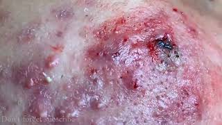 CYSTIC ACNE REMOVAL  Inflammatory Acne Acne Skin Treatment [upl. by Gudrin]