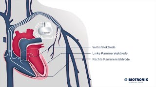 CRT Therapie bei Herzschwäche Animation Medizin [upl. by Innek443]