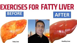 Fatty Liver Exercise  Fatty Liver Treatment Without Medicine fattyliver liverdisease liverhealth [upl. by Lleret]