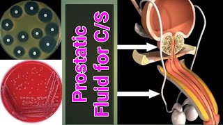 Prostatic fluid for culture and sensitivity CS test [upl. by Nagem689]