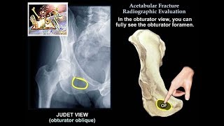 Acetabular Fracture Radiographic Evaluation  Everything You Need To Know  Dr Nabil Ebraheim [upl. by Aerdnwahs]