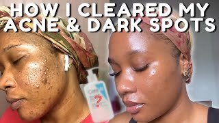 HOW I CLEARED MY ACNE BREAKOUTS AND DARK SPOTS NO TRETINOIN  iJay Amadi [upl. by Paxton405]