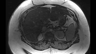 Hepatic Steatosis [upl. by Annahsad]