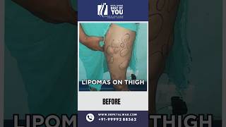 Lipoma on Thigh Arm Abdomen  Lipoma Treatment by Expert Surgeon Dr PK Talwar [upl. by Nileuqay]