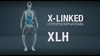 Xlinked hypophosphatemia XLH mechanism of disease [upl. by Mcclish]