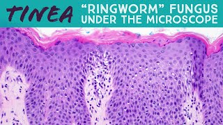 quotRingwormquot under the microscope tinea dermatophytosis fungal folliculitis Majocchi pathology [upl. by Alida]