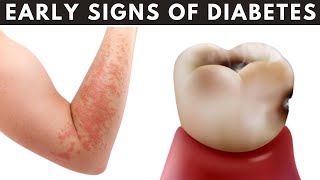 12 Warning Signs Of Diabetes [upl. by Bove]