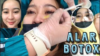 PROCEDURE FOR ALAR BOTOX SEE THE RESULT [upl. by Itsyrk]