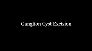 GANGLION CYST SURGERY [upl. by Burchett]