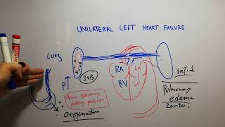 CVS 218  Unilateral left heart failure  Pathophysiology of Acute pulmonary edema [upl. by Ofelia341]