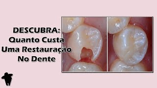 Descubra Se Você Realmente Precisa de uma Restauração no Dente e Qual o Preço Deste Tratamento [upl. by Danziger]