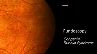 Congenital Rubella Syndrome Retinopathy Fundoscopy [upl. by Landre]