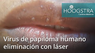 Virus de papiloma humano eliminación con láser 19034b [upl. by Converse288]