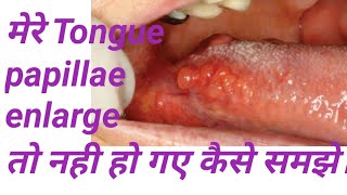 Tongue papillae enlarge हो गए यह कैसे समझे Tongue papillae location folliate circumvallet papillae [upl. by Mindy]