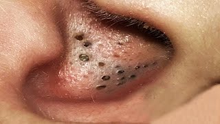 Big Cystic Acne Blackheads Extraction Blackheads amp Milia Whiteheads Removal Pimple Popping  4226 [upl. by Lyrac]