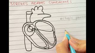 STROKESADAMS SYNDROME  Rhythmical Excitation Of The Heart Chapter 10 Physiology [upl. by Nura]