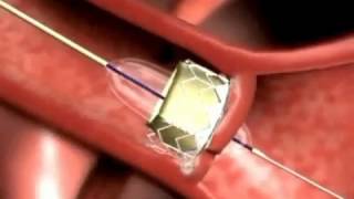 Edwards Sapien Transcatheter Heart Valve [upl. by Esyned]