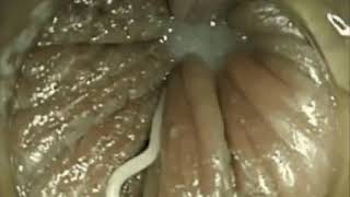 Enterobius vermicularisPinworm Infection [upl. by Plumbo]