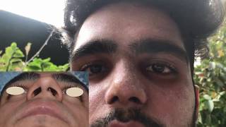 How To Reshape Nose Bone Naturally  Get Sharp and Straight Nose in 14 minutes [upl. by Ymmak293]