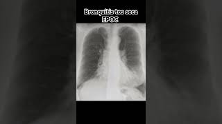 BRONQUITIS TOS SECA EPOC [upl. by Aehs614]