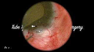 Tube Tying in Baerveldt Tube Glaucoma Surgery [upl. by Vokaay717]