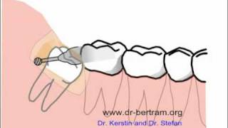 Animation protocole dextraction dune dent incluseflv [upl. by Haronid77]