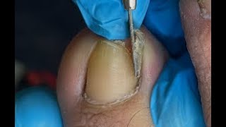 Ingrown toenail surgery [upl. by Wakefield]