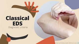 Classical EhlersDanlos Syndrome Diagnostic Criteria [upl. by Maudie]