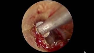 Miringoplastica endoscopica step by step [upl. by Anauqal136]