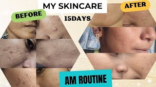 AFTER 15DAYS SKINCARE🫰MY FaceTotally Changed😲EveryProduct Explain Detailedly👍 skincareroutine acne [upl. by Eittik]