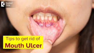 Mouth Ulcer Mouth Sores Symptoms Treatment amp Prevention MethodsDrLahari ASR  Doctors Circle [upl. by Yelad911]