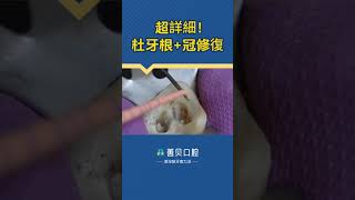 【深圳杜牙根醫院推薦】杜牙根之後需要笠牙套嗎  杜牙筋  全瓷牙套  杜牙根流程時間  善貝口腔公開治療程式 [upl. by Farmelo895]