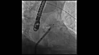 “Ground Zero”  LAA Occluder Implant [upl. by Perusse]