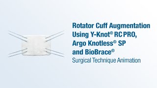 Rotator Cuff Augmentation Using YKnot® RC Pro Argo Knotless® SP and BioBrace®  CONMED Animation [upl. by Ettedualc79]