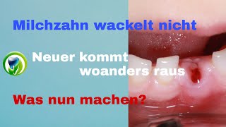 Der Milchzahn wackelt nicht und der nächste bleibende Zahn kommt woanders raus [upl. by Roland698]