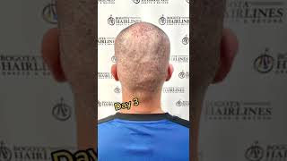 Donor area recovery after an fuehairtransplant hairtransplant hairtransplantcolombia [upl. by Philine]