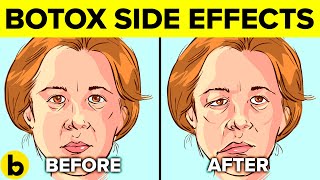 5 Side Effects Of Botox Injections You Should Be Aware Of [upl. by Calen]