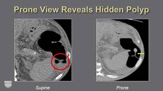 Tumor Imaging CT Colonography  Course Sample [upl. by Anerda]