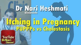 Itching in Pregnancy PUPPPs vs Cholestasis of Pregnancy Discussed by Dr Nari Heshmati [upl. by Omlesna313]