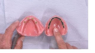 Case of the week Placing a Removable Lower Denture Attached to Implants [upl. by Charmion]